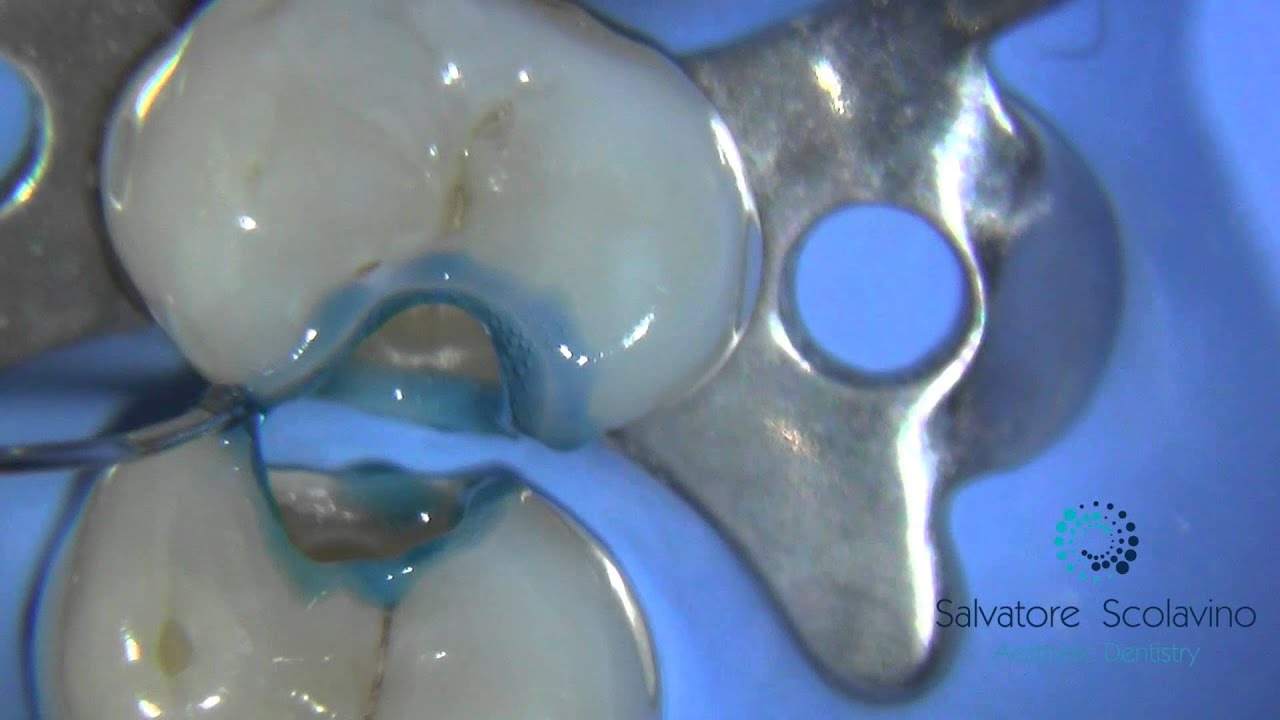 Selective Enamel Etching