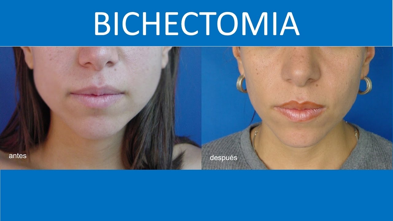 Bichectomia Para tener un rostro más delgado | Cirugia para los cachetes