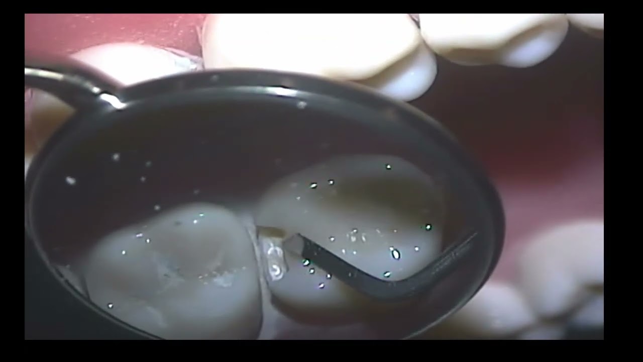 Class II Slot Preps - 3 teeth - Duggan Oral Design
