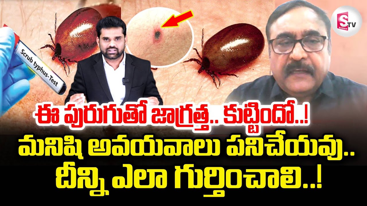 Dr.Paparao About Scrub Typhus in Ap | Telugu Latest News Updates | స్క్రబ్ టైఫస్ పురుగు తో జాగ్రత్త
