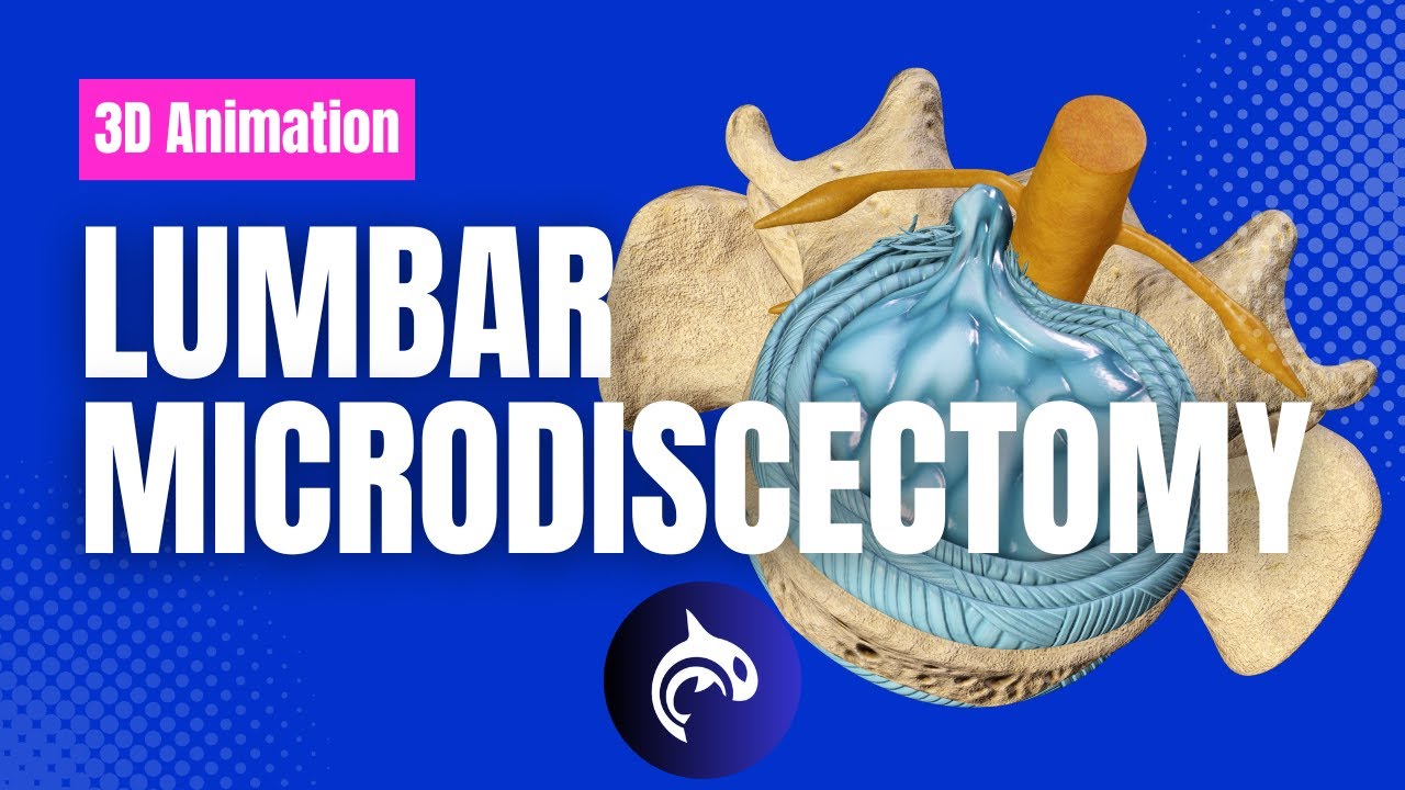 Поясничная микродискэктомия &mdash; 3D-анимация