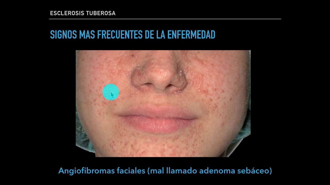 Enfermedad autosómica dominante: Esclerosis tuberosa