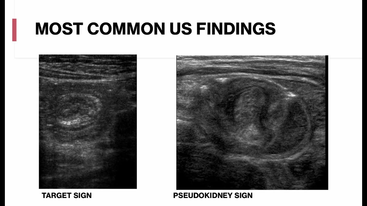 Pediatric Abdominal Ultrasound - Appendicitis, Intussusception, Mesenteric Adenitis