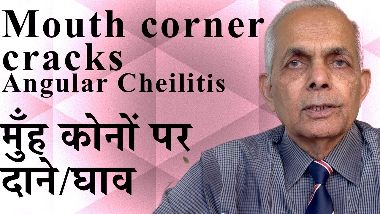 Angular Cheilitis / Cracking and redness of the corners of the mouth