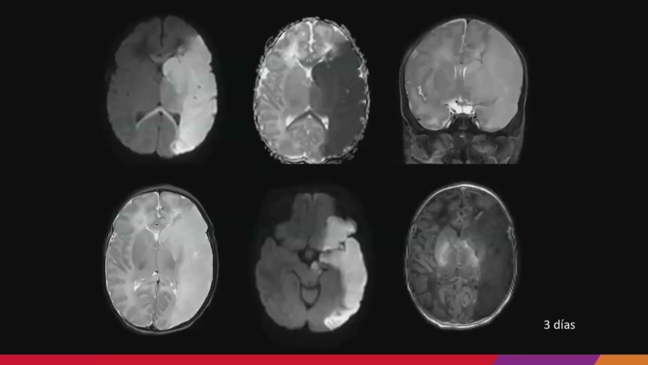 La neuroimagen pre y post-hemisferectomía. Jordi Muchart