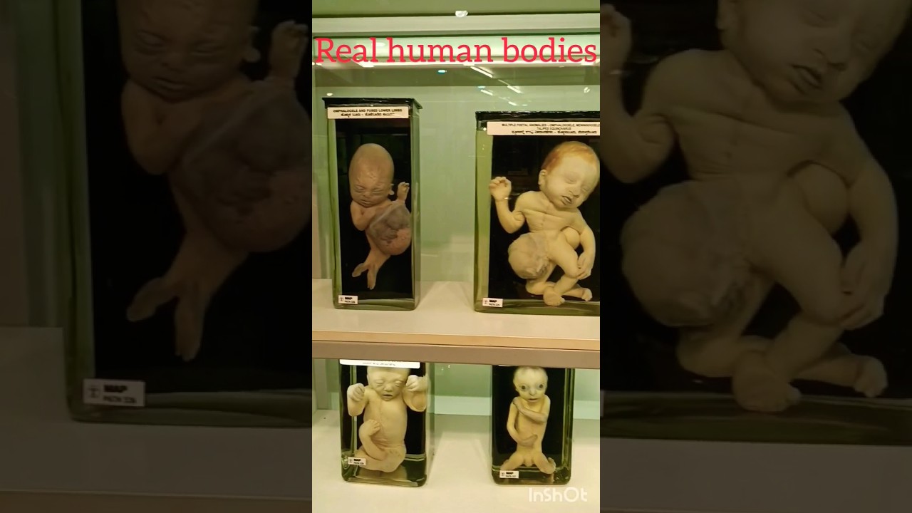 Real human bodies.Manipal museum of Anatomy & Pathalogy#Manipal#truth#believe#india#mindblowingfacts