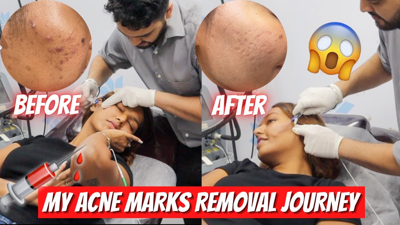 My Acne Marks/Scars Removal Treatment Journey | 