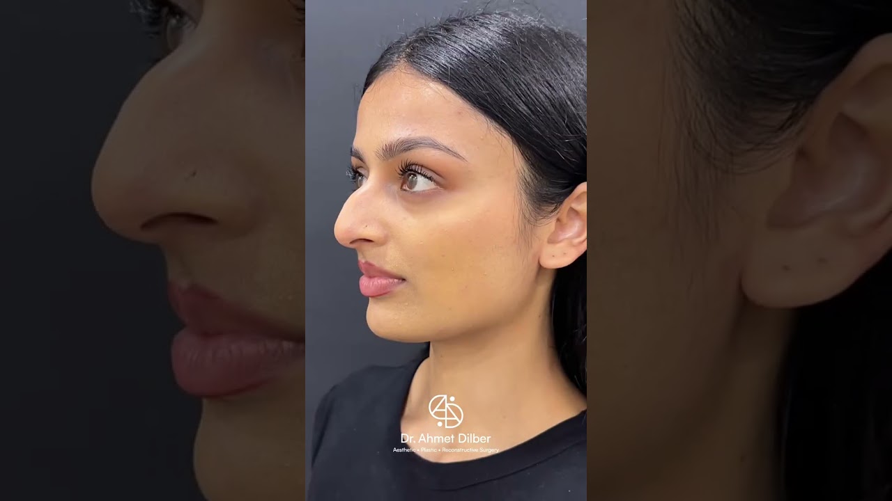 Rhinoplasty Turkey 👃🏻 Dr. Ahmet Dilber 🪄 