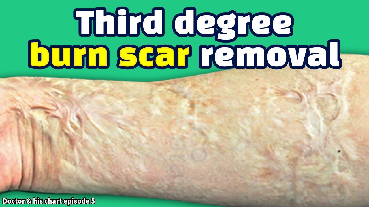 ［scar clinic in korea］Burn scar(arm) removal treatment -Third degree burn scar removal