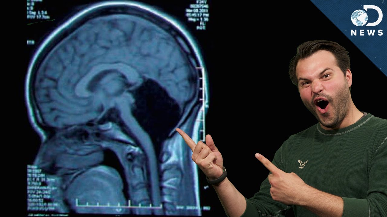 How Can You Survive Without Part Of Your Brain?
