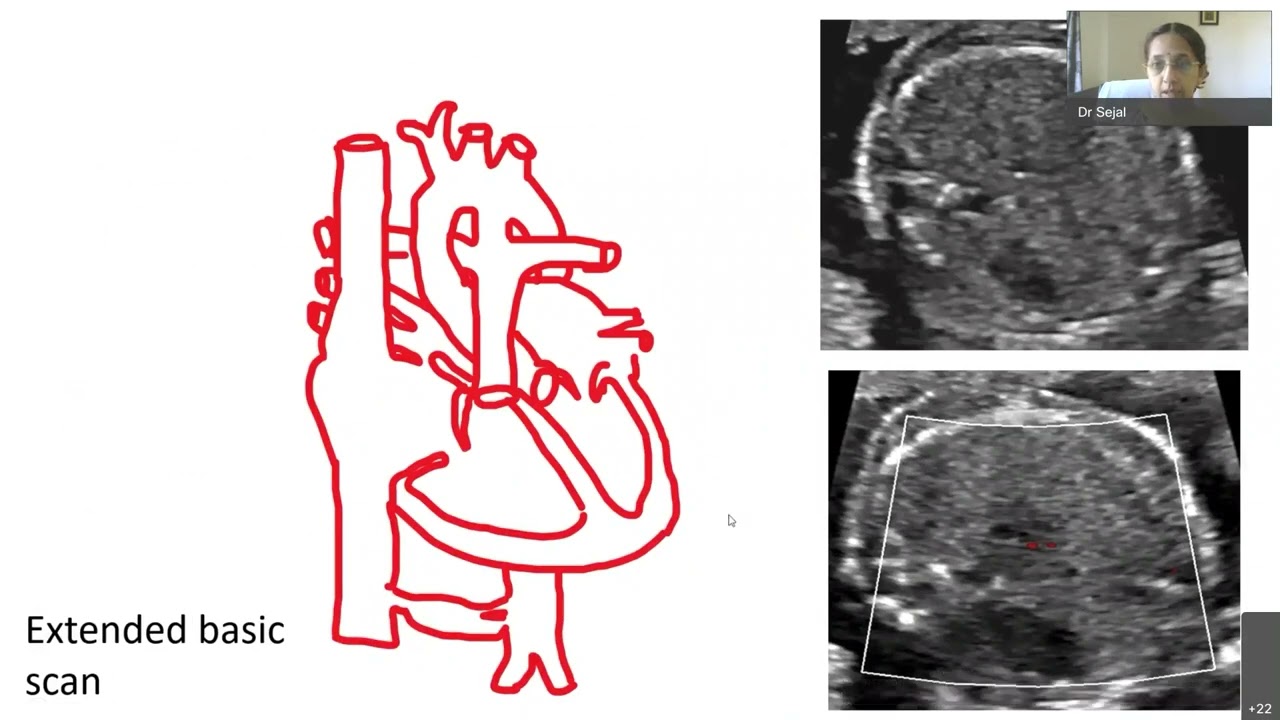 Fetal echo series #5 by Dr Sejal Shah