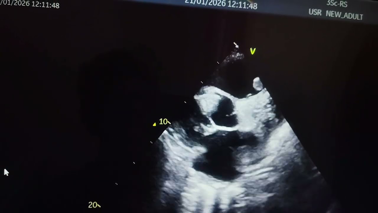 Dilated LA/LV/RA, Global hypokinesia of LV, severe LV dysfunction, RV clot echo video