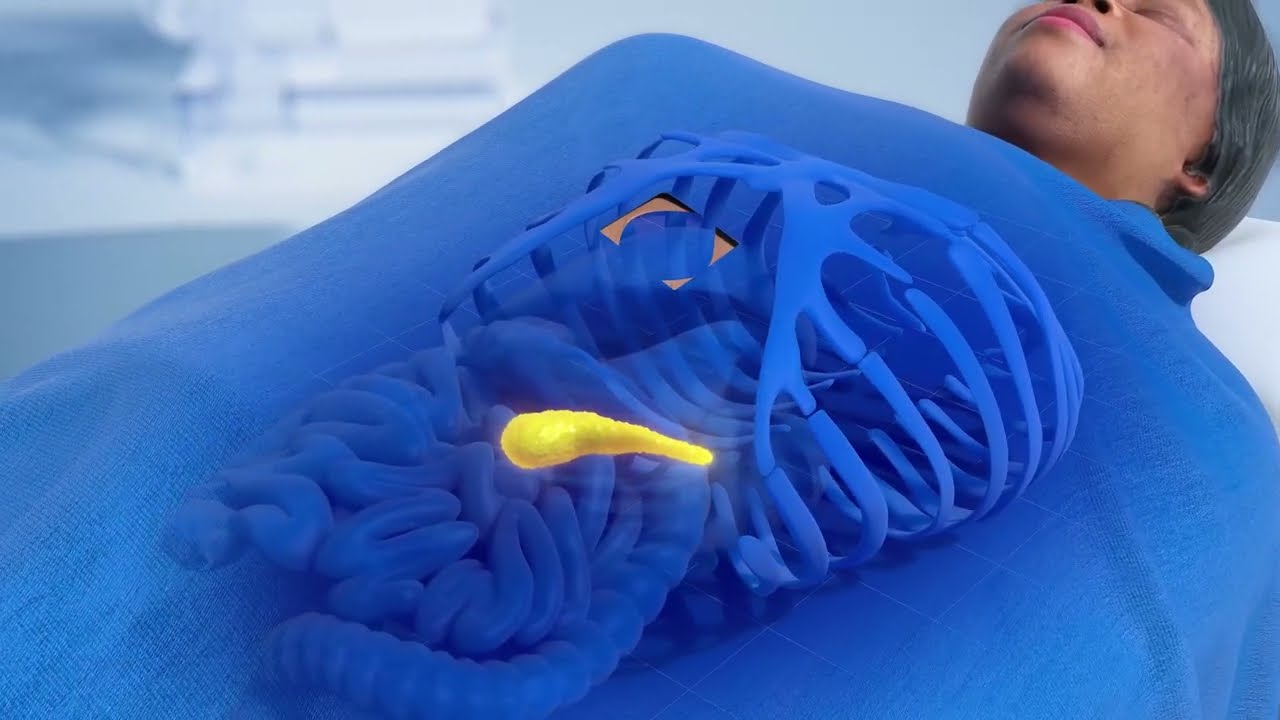 Pancreatic Cancer Treatment with IntraOp&reg; Mobetron&reg;