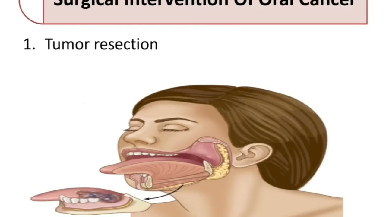 Gastrointestinal disorder .   oral cancer  (  Chap -1) Adult Health Nursing   . .  BSN