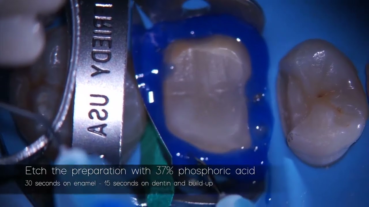 Tecnica di cementazione overlay in ceramica Ibrida
