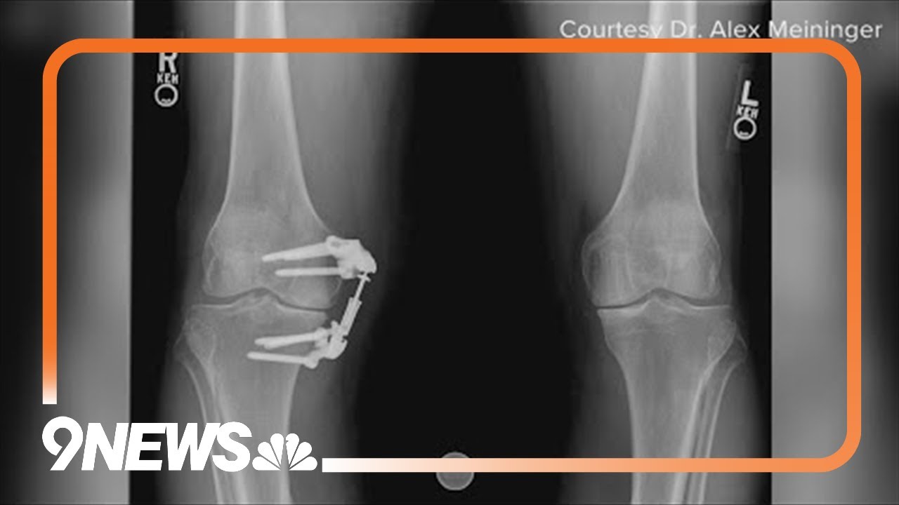 Doctor explains medical device that offers alternative to knee replacement