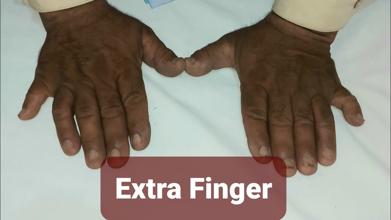 Polydactylism - Extra Fingers