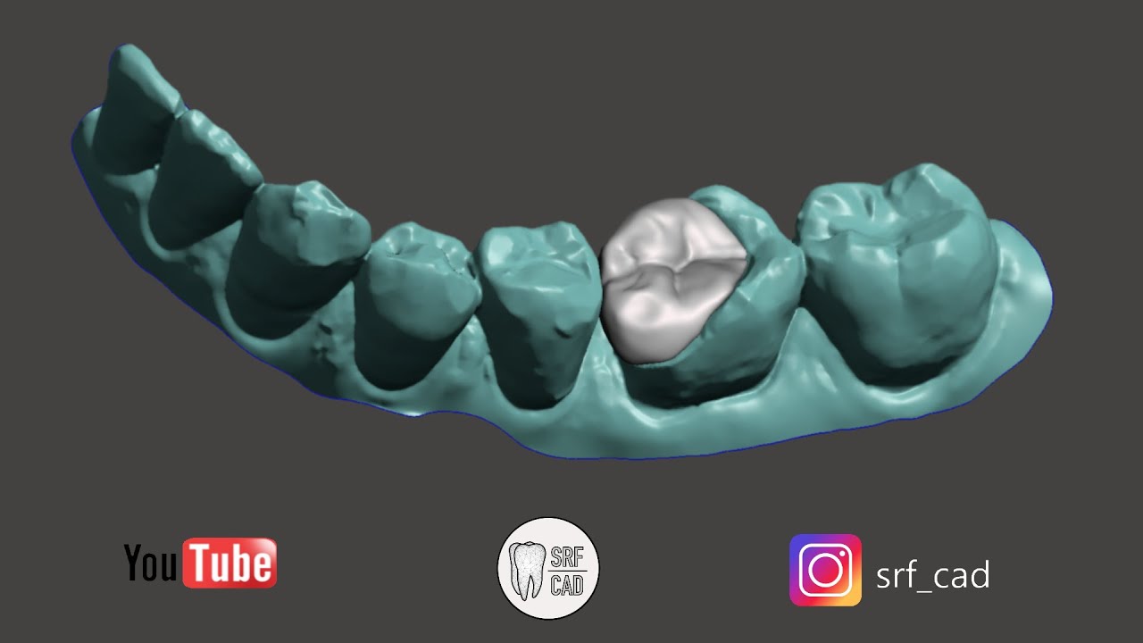 MESHMIXER DENTAL : COME CREARE UN INTARSIO INLAY TEMPORARY  MONOLITHIC INTRAORAL SCAN ZIRCONIA FREE