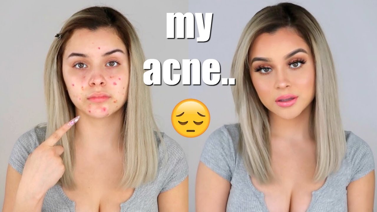 my acne insecurity.. | Aidette Cancino
