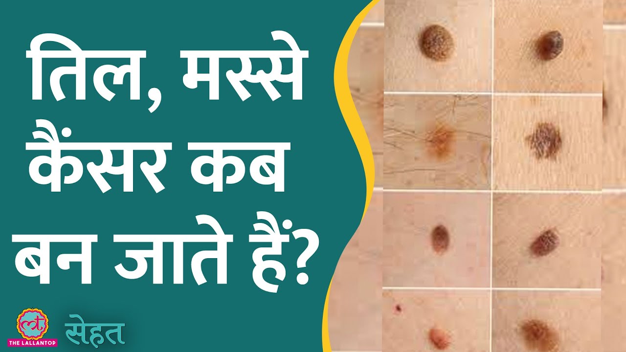 शरीर पर तिल, मस्से होना आम बात है, पर ये Cancer में भी बदल सकते हैं! | Sehat ep 633