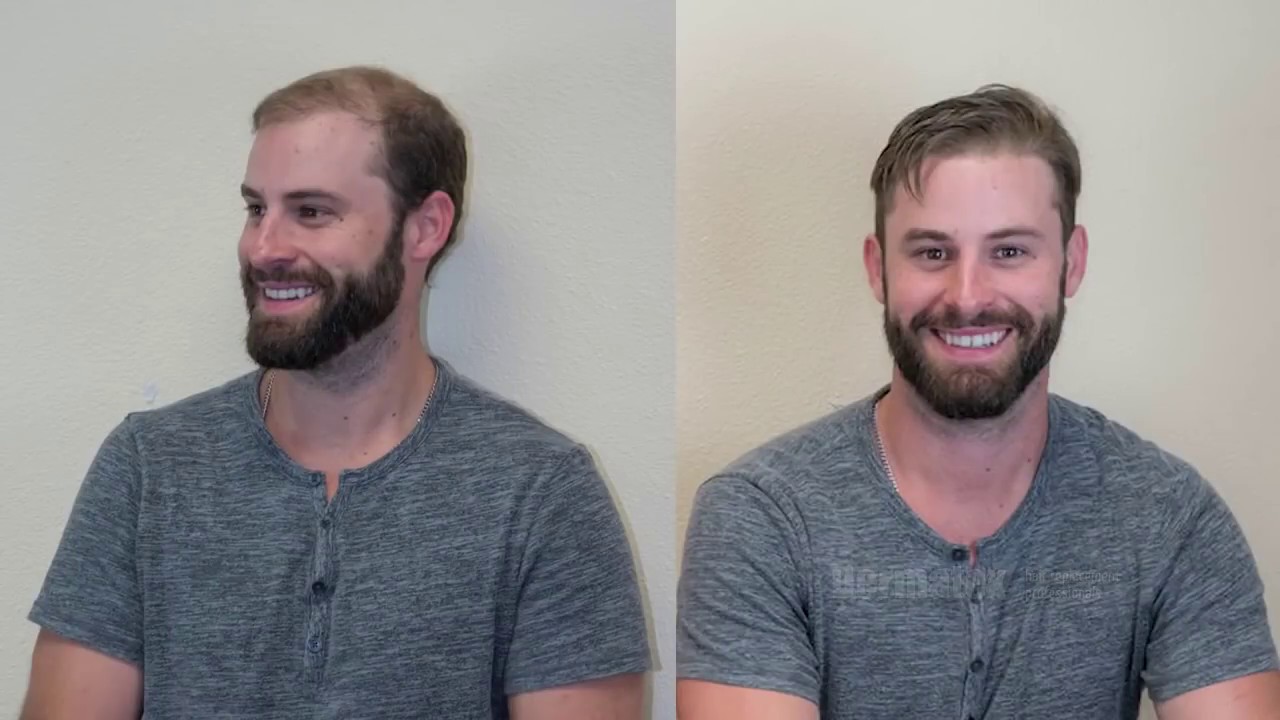 Elliott  Men's Non Surgical Hair Restoration | Dermatex Hair Replacement, San Diego Orange County CA