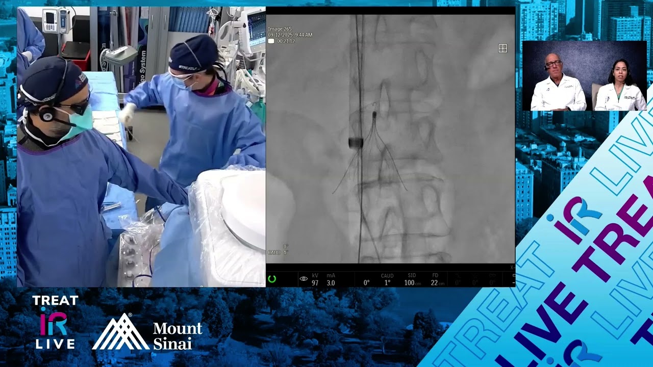 Transjugular Endovascular Forceps Retrieval of a 10 year old Indwelling IVC Filter