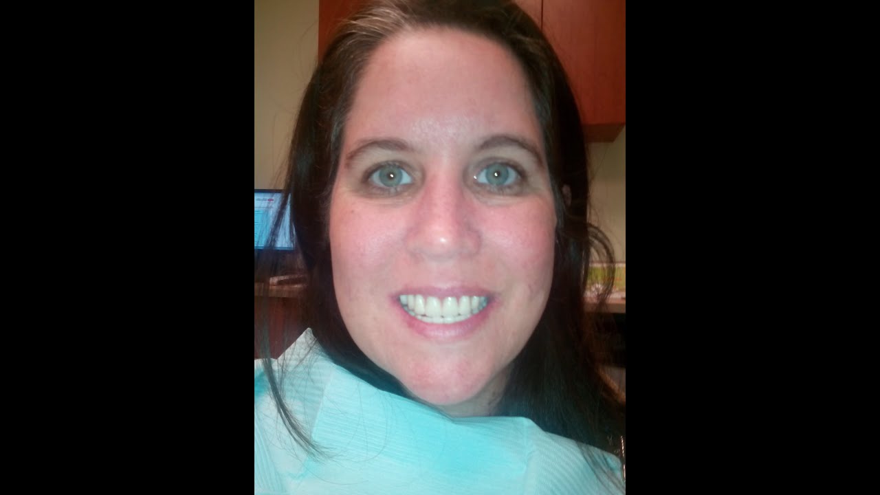 Denture Wax Try In #2