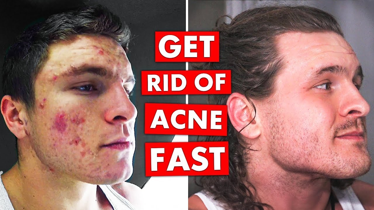 5 DO's & DON'TS To Get Rid of Acne FAST!