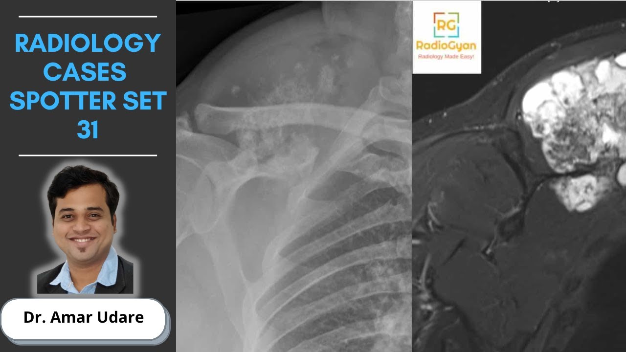 Approach to Imaging of Bone Tumors and 10 High-Yield MSK Quiz Cases | Spotter Set 31 and 31A