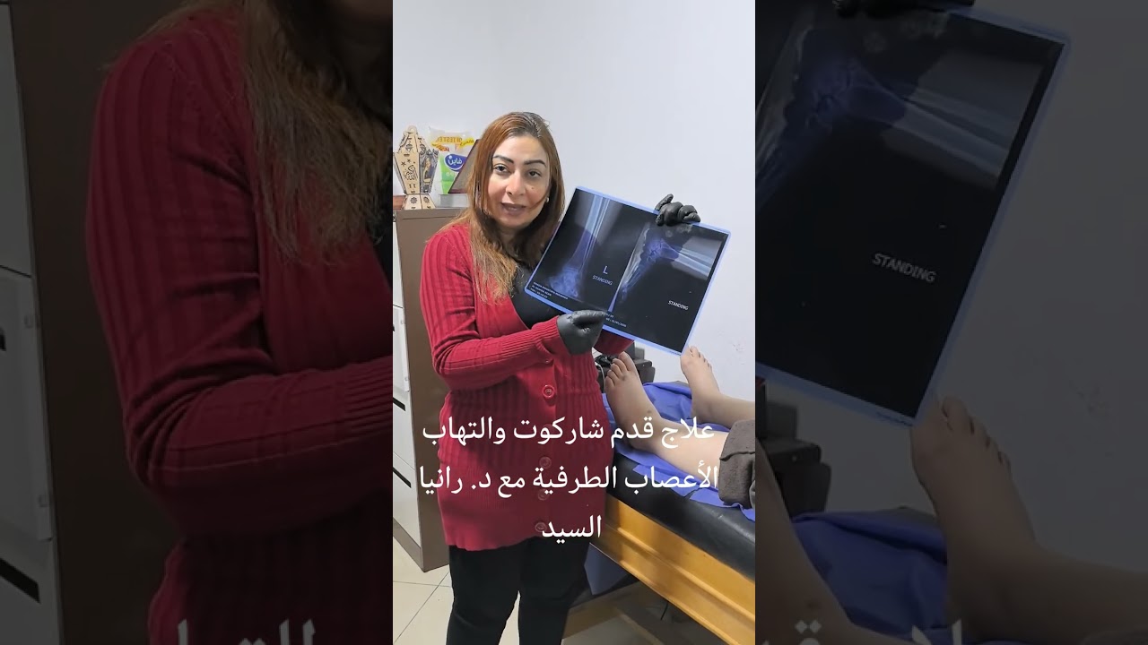 علاج القدم الشاركوت مع د. رانيا السيد 