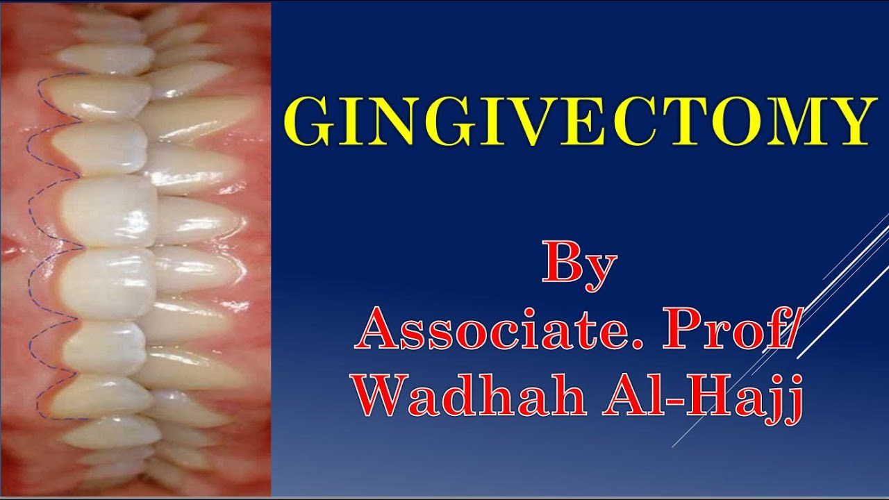 35- Periodontal surgery – 4  (Gingivectomy) - Dr Wadhah Periodontology lectures.د/ وضاح الحاج