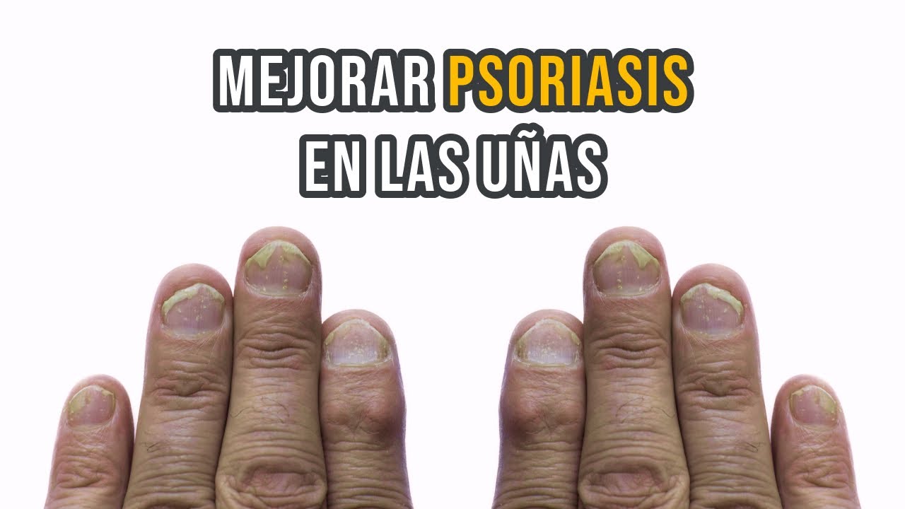 C&oacute;mo mejorar la psoriasis en las u&ntilde;as | #Shorts