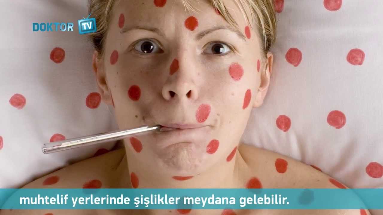 Kızıl hastalığı