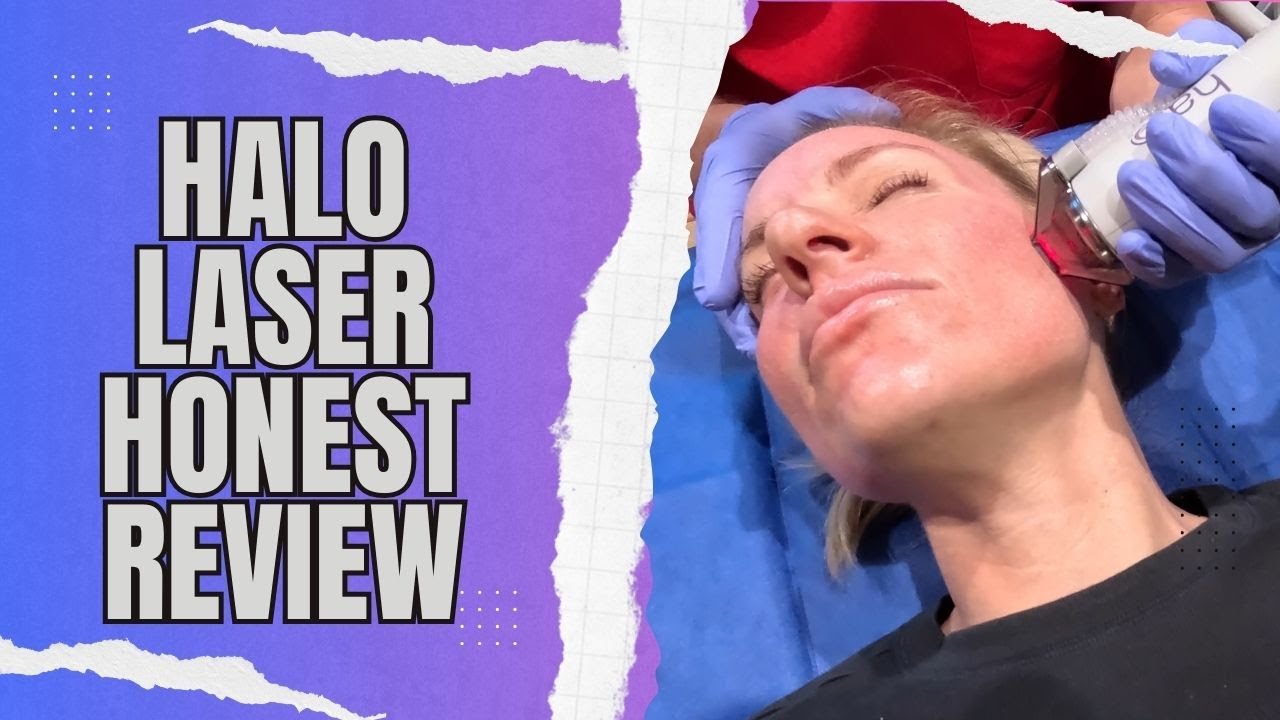 My Halo Laser Procedure, Day by Bay Recovery and Brutally Honest Review! / Tips for Faster Recovery