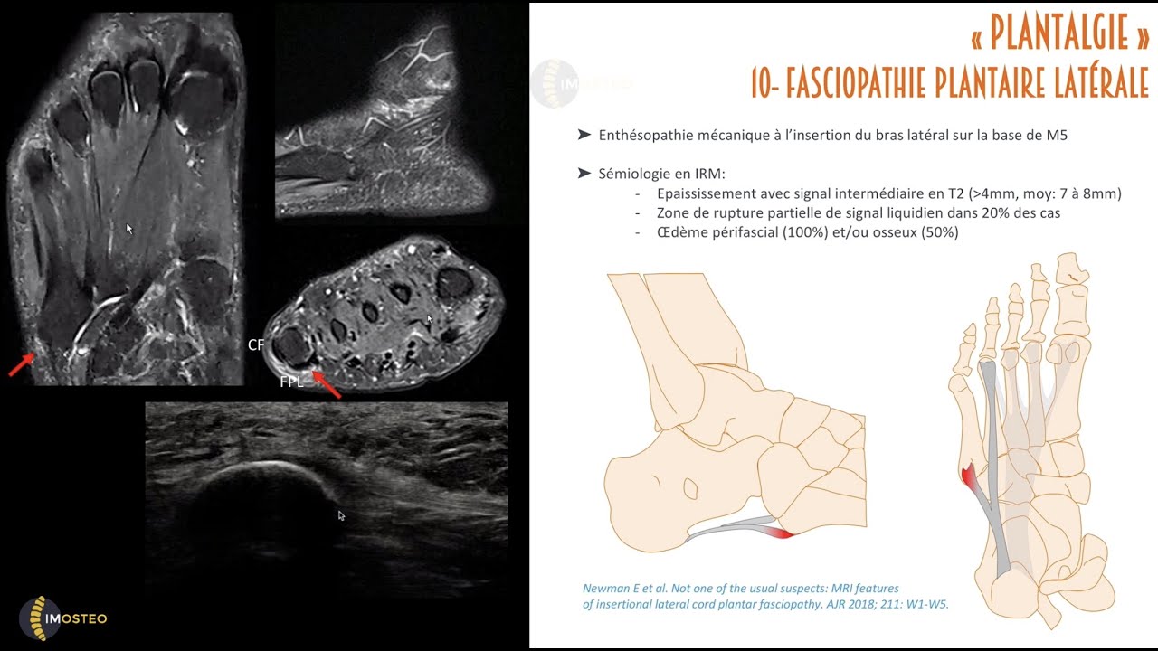 Tutoriel Imosteo #22 : Talalgies- Causes et exploration par l'IRM