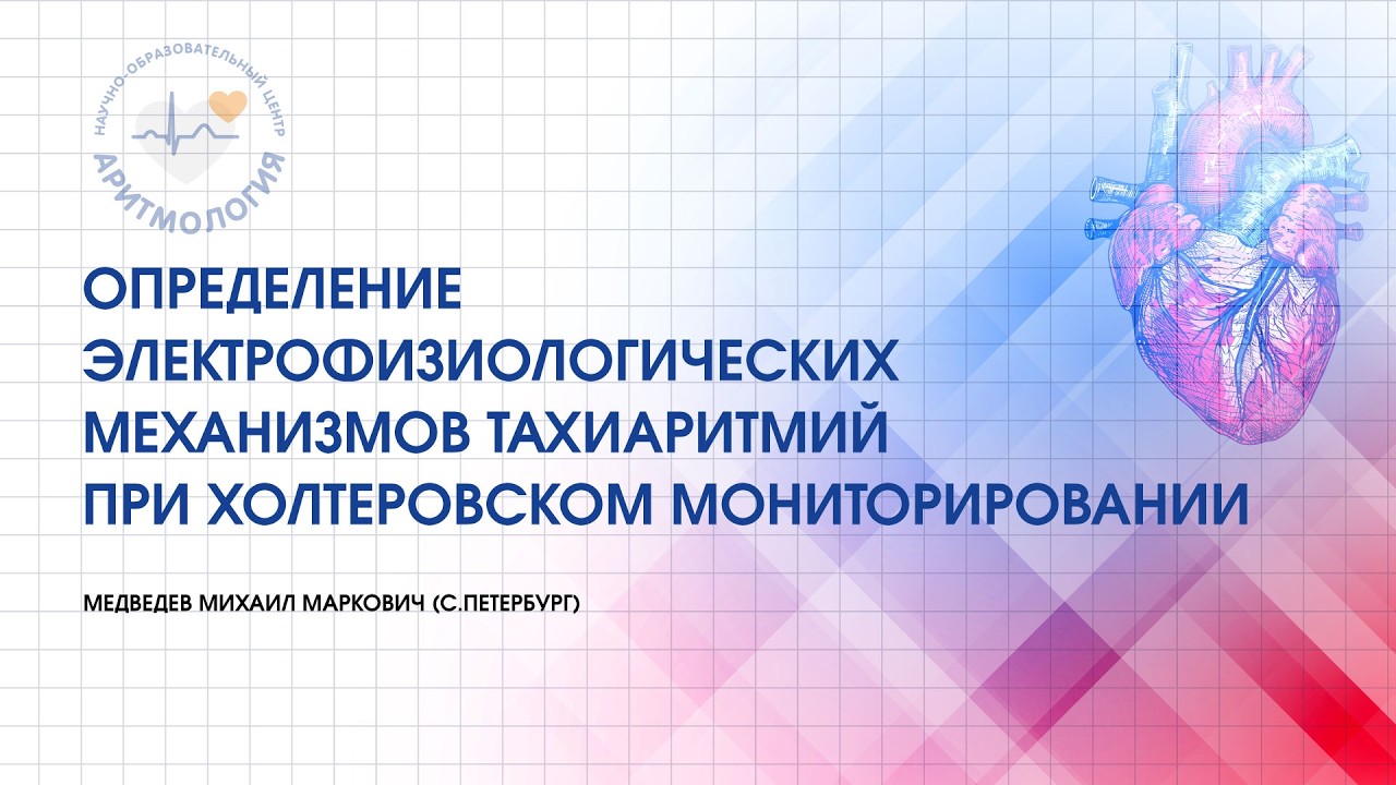Определение электрофизиологических механизмов тахиаритмий при холтеровском мониторировании