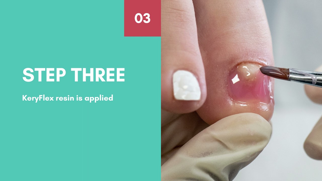 KeryFlex Nail Restoration | Podiatrist Sydney