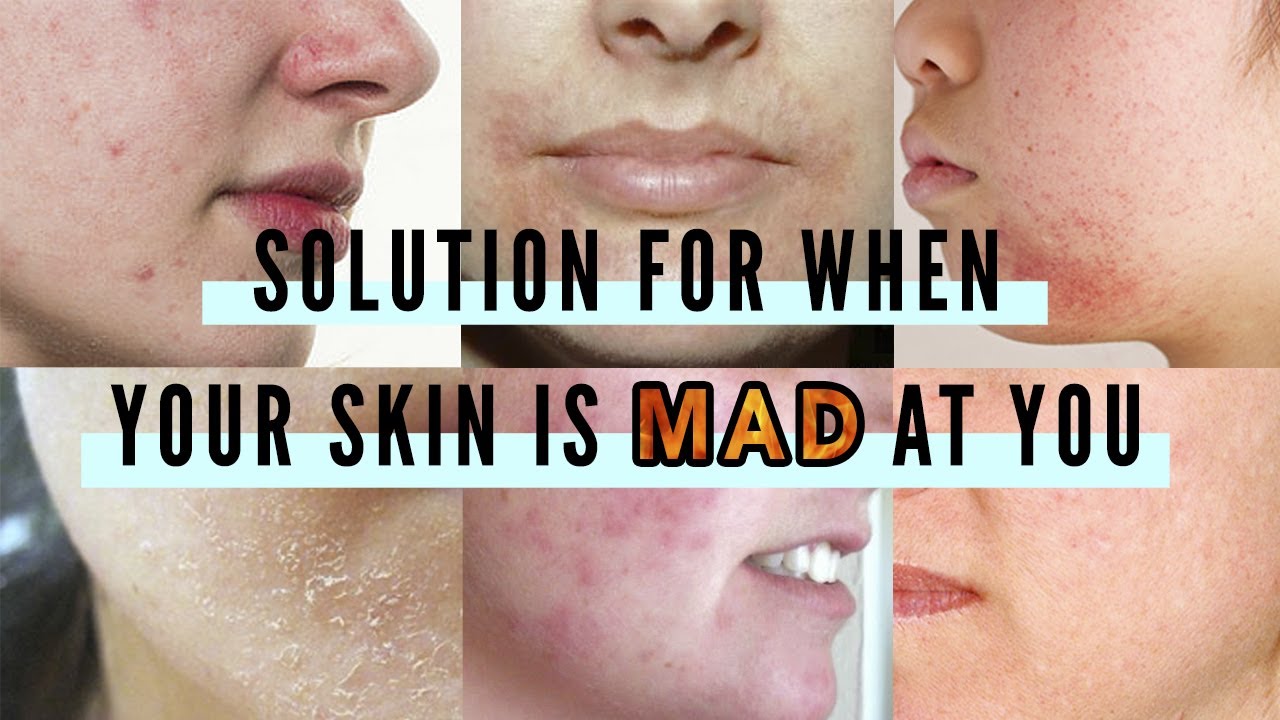 How To Calm Down Sensitive Skin • Irritation • Post-acne : Cica, Madecassoside Creams