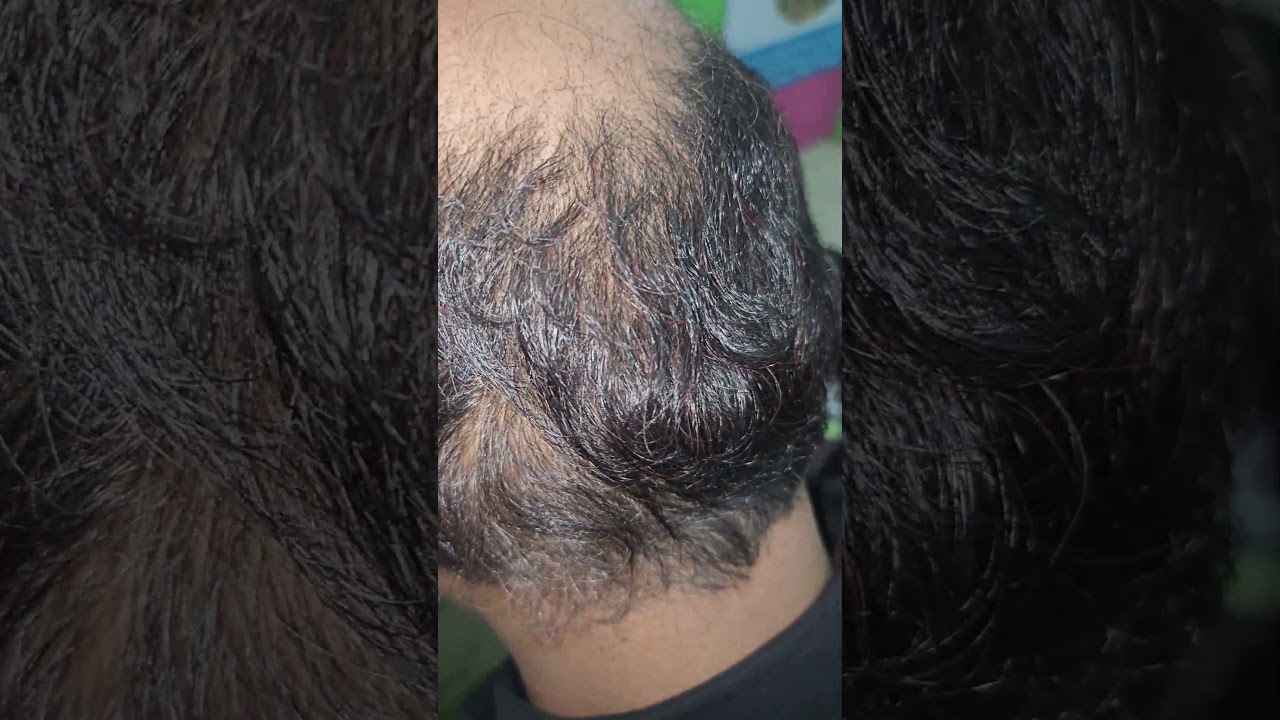 PRP Therapy @ IM WELL CLINIC www.imwell.in 