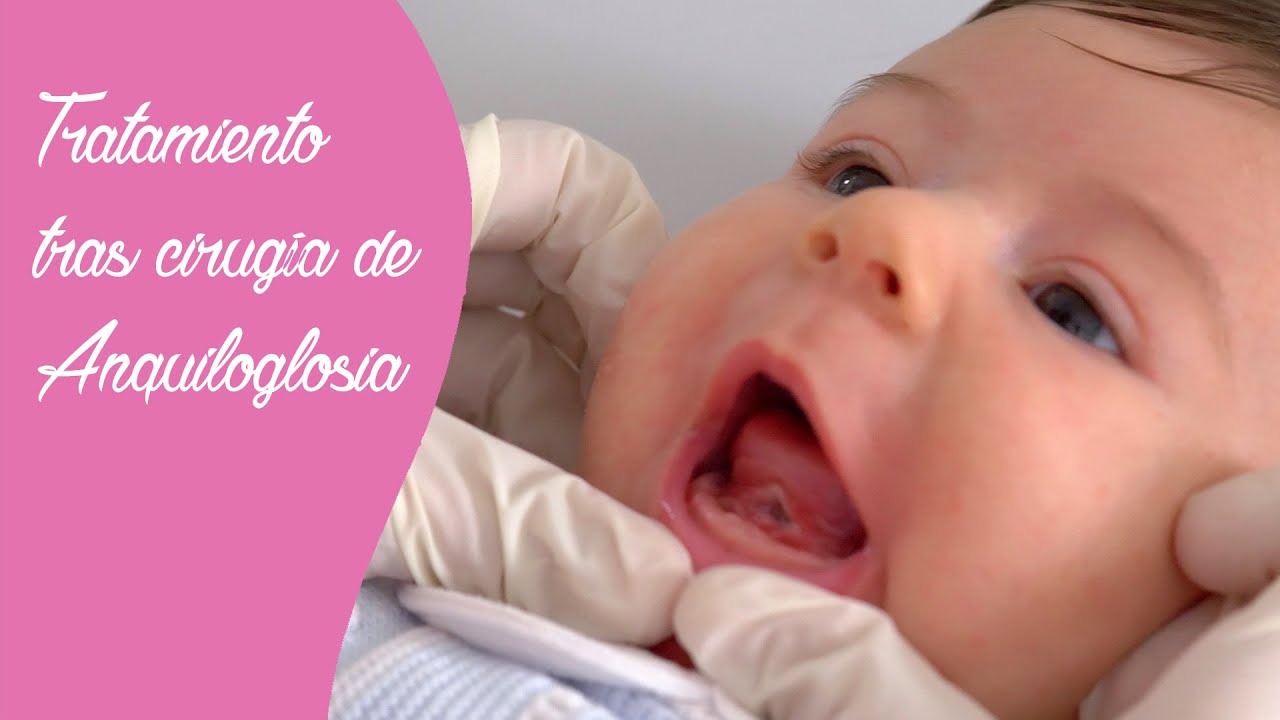 Tratamiento tras la cirugía de anquiloglosia o frenectomía lingual. 👅👶🏼