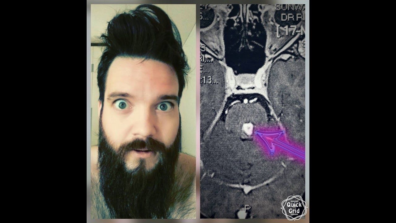 Cavernoma Chronicles: the day my life changed forever