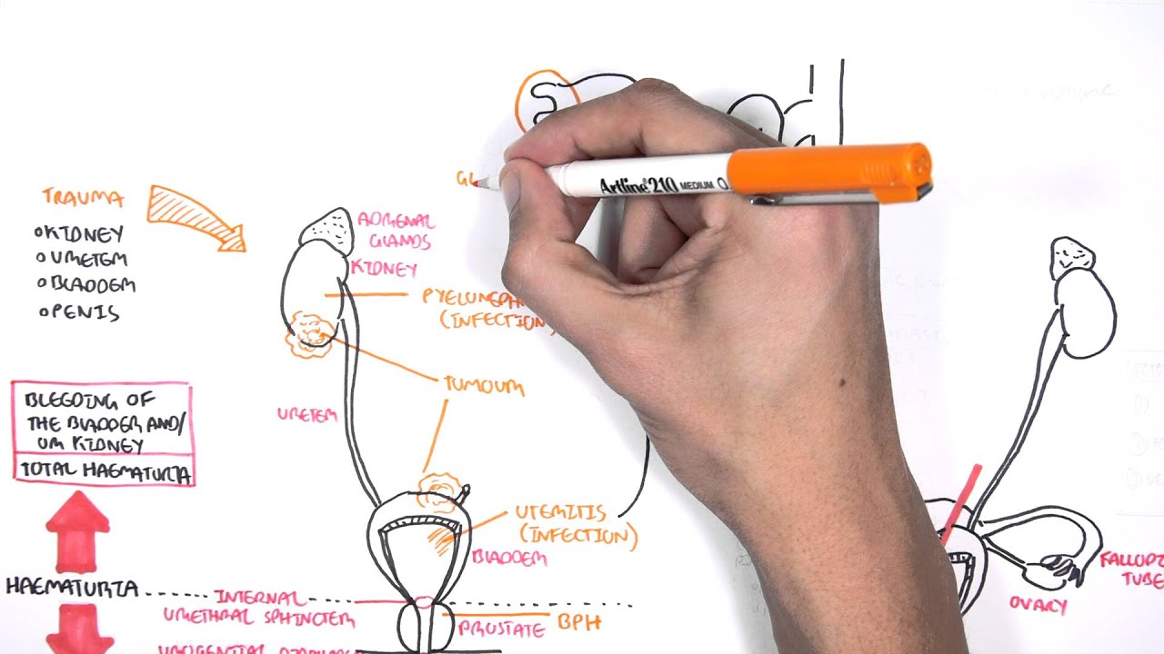 Causes of Haematuria