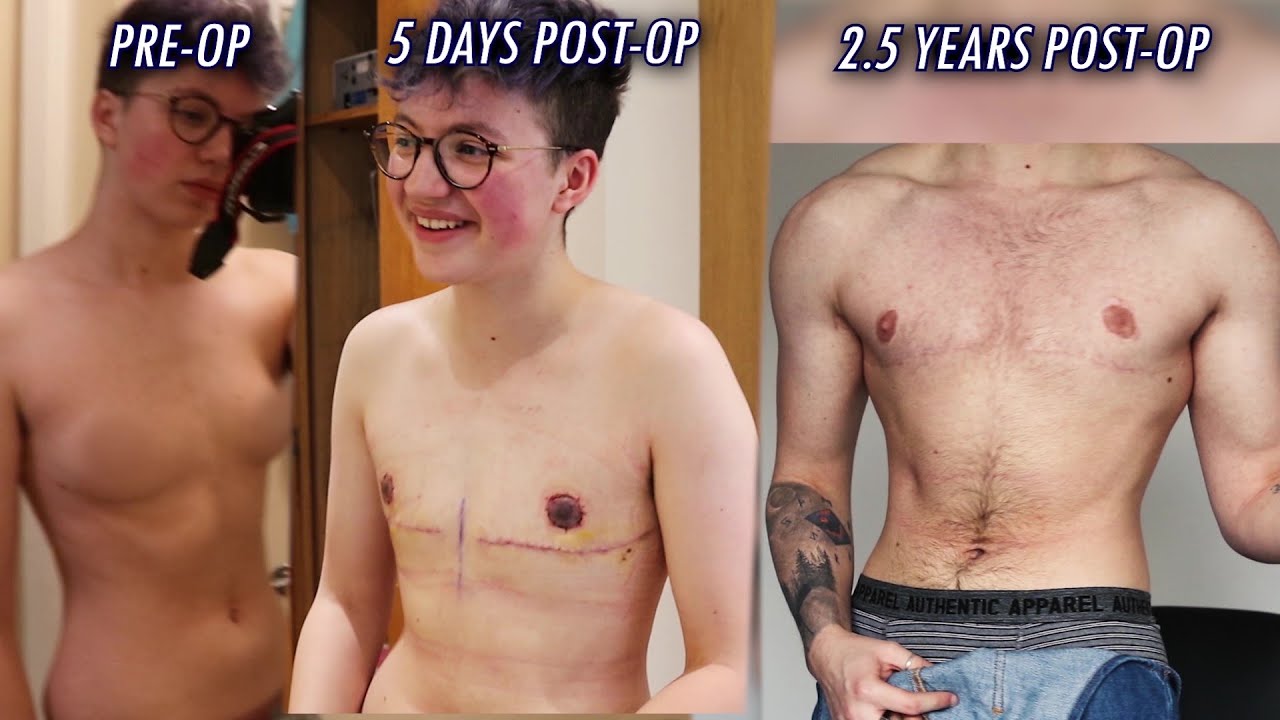 TOP SURGERY RECOVERY TIMELINE: Pre-Op -- 2.5 Years Post-Op (FtM)