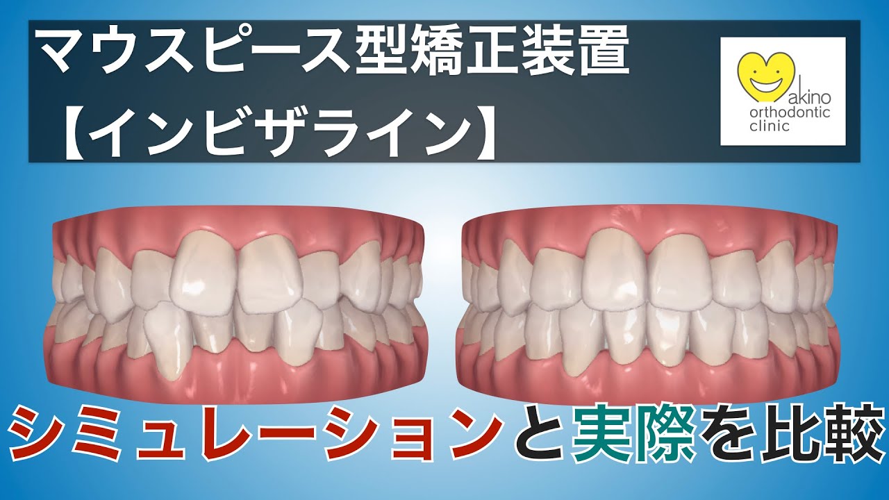 インビザライン矯正はシミュレーション通りに動く！