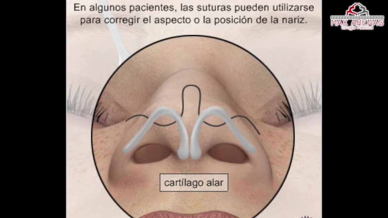 Rinoplastia Tecnica Cerrada