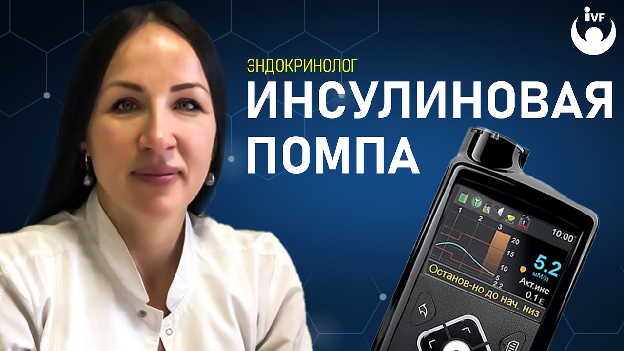 Инсулиновая помпа и лечение сахарного диабета. Эндокринолог Екатерина Маляр