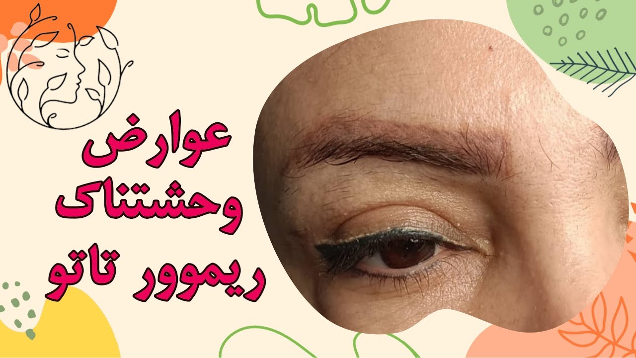 عوارض ریموور تاتو ابرو و صورت | درمان گودی، اضافه گوشت و قرمزی بعد از ریموور تتو | آموزش عوارض ریموو