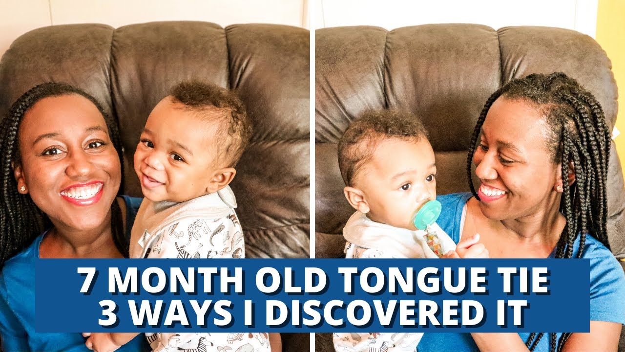 Tongue Tie Formula Fed Infant | 3 Signs Of Tongue Tie in Baby