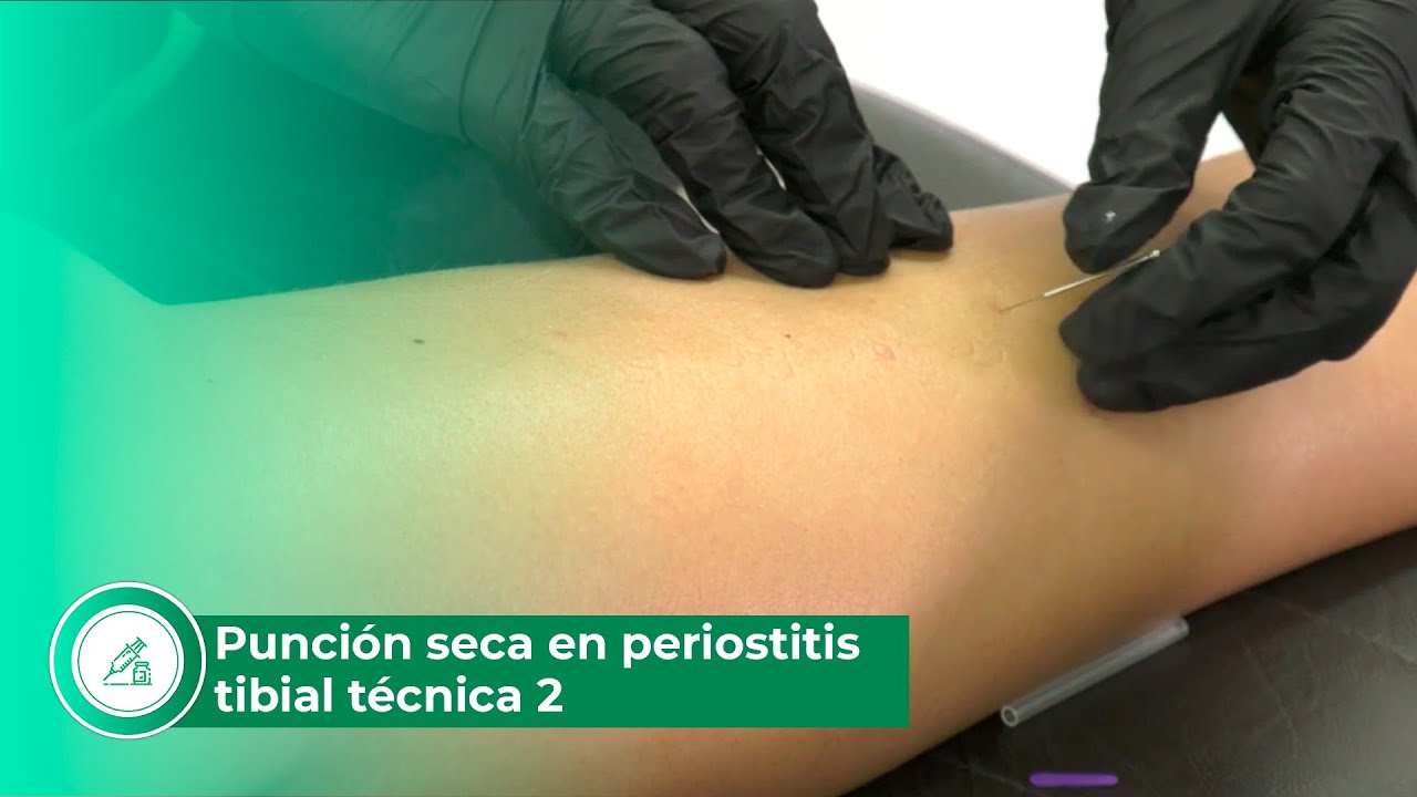 Punción seca en periostitis tibial técnica 2
