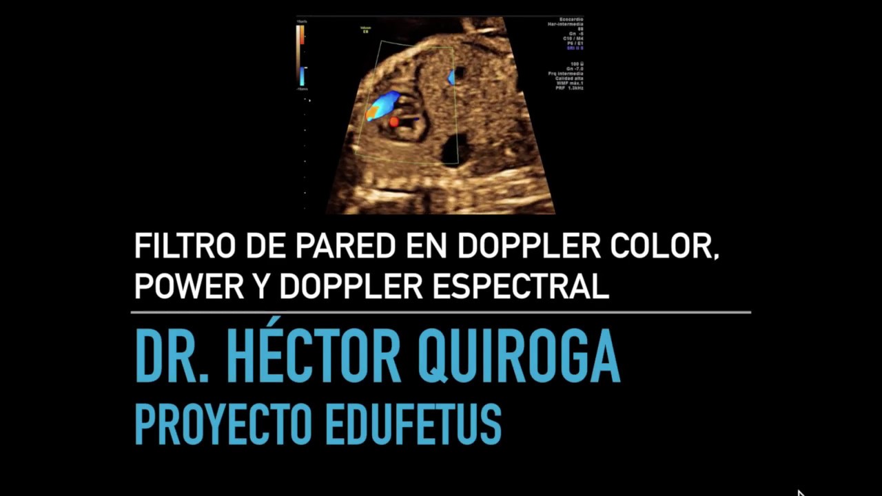 Filtro de pared en Doppler  Color, Power y Doppler Espectral